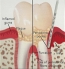 Periodontal Exam - The measurement of gum pockets and gum disease detection